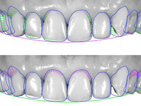 Diseño de sonrisa: ¿qué es y por qué cada sonrisa debe ser única?