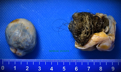 TERATOMA BILATERAL.JPG