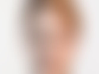Profhilo: Wat is het?