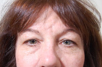 Eyelid-Surgery-before-1373991-2048473.jp