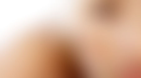 MANCHAS PÓS-SOL. COMO TRATÁ-LAS?