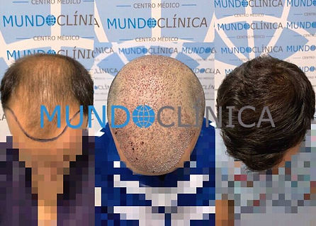 injerto-capilar-resultados.jpeg