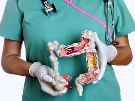 Ruszył program bezpłatnych badań przesiewowych raka jelita grubego