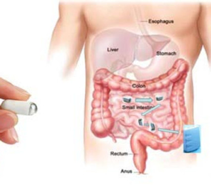 Wireless-capsule-endoscopy-and-multiple-