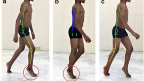 Protocolo de uso de la Edinburgh Visual Gait Score en niños con parálisis cerebral para facilitar el análisis de la marcha por observación
