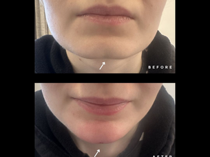 After image showing reduced chin crease and better definition