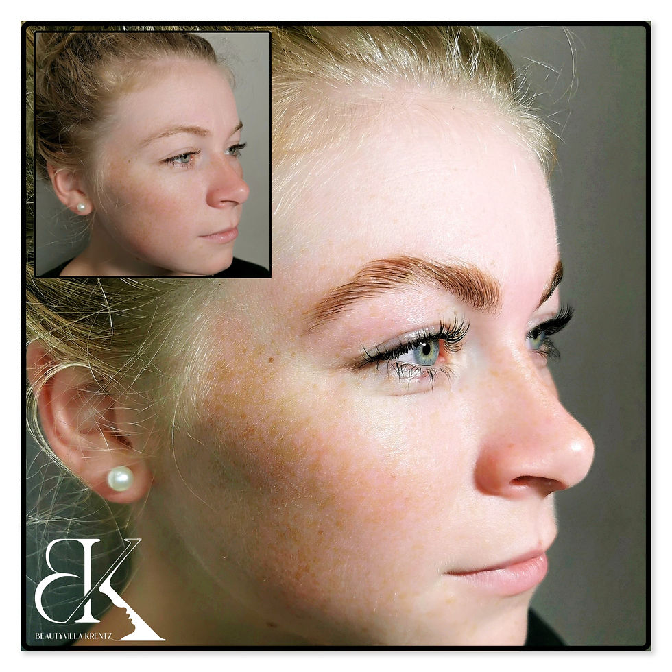 Augenbrauenlifting / Brow-Lifting