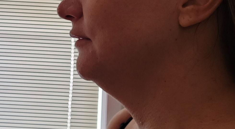 The Sculpt Spot Facial Sculpting Chin/Neck Lift Before