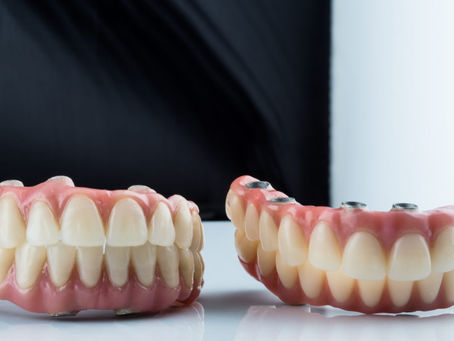 Implante ou Dentadura em Salvador: Qual a Melhor Opção Para Você?