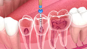 Endodontia em Salvador: Tratamento de Canal Sem Medo e Com Mais Conforto do Que Você Imagina