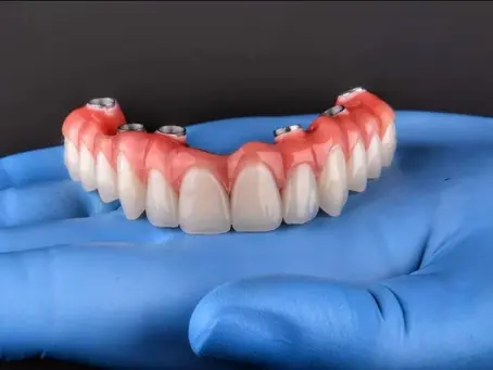 Implante em Salvador: Quanto Tempo Dura um Implante Dentário?