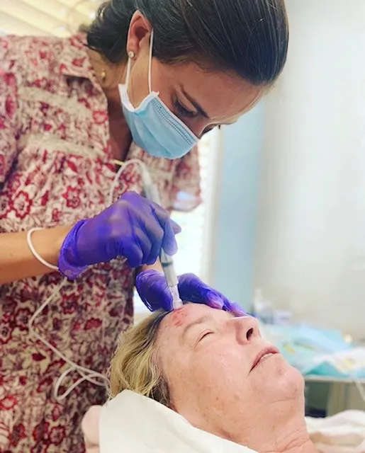 Microneedling