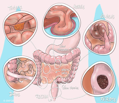 occlusion_intestinale_aigue_illustration