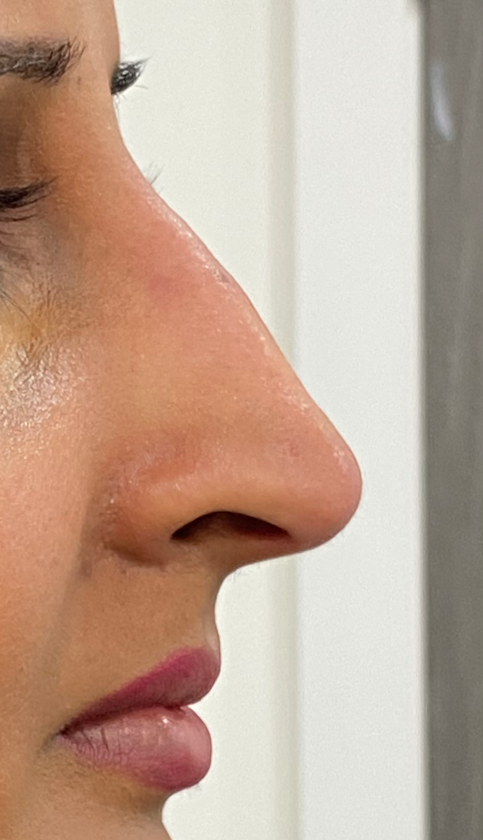 Image of non-surgical rhinoplasty