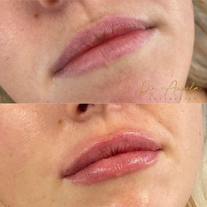 Lip filler 3.jpg