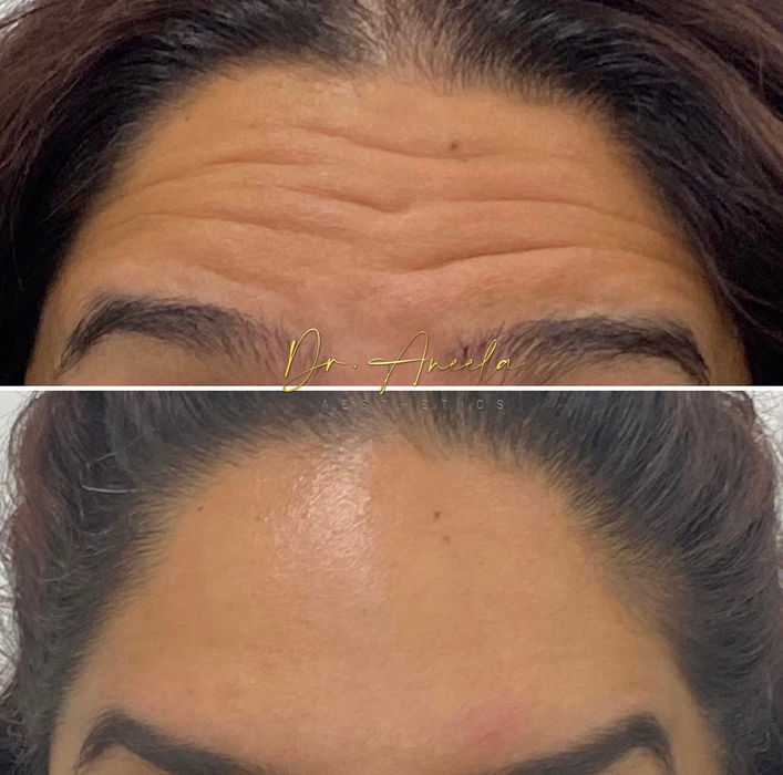 Forehead botox 4.JPG