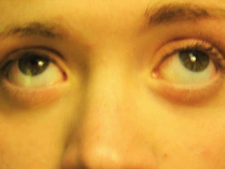 Eye Issues
