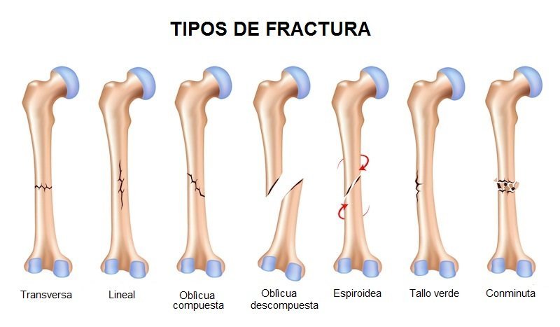 Resultado de imagen para Fracturas