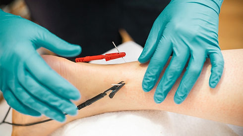 electro-accupuncture-session-1296x728-header.jpg