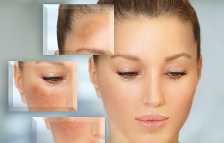 Best Laser Treatments for Sun Damage and Hyperpigmentation in Cleveland