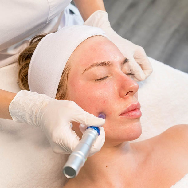 DSC09049_microneedling.jpg