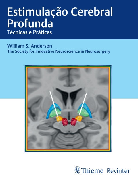 Estimulação cerebral profunda