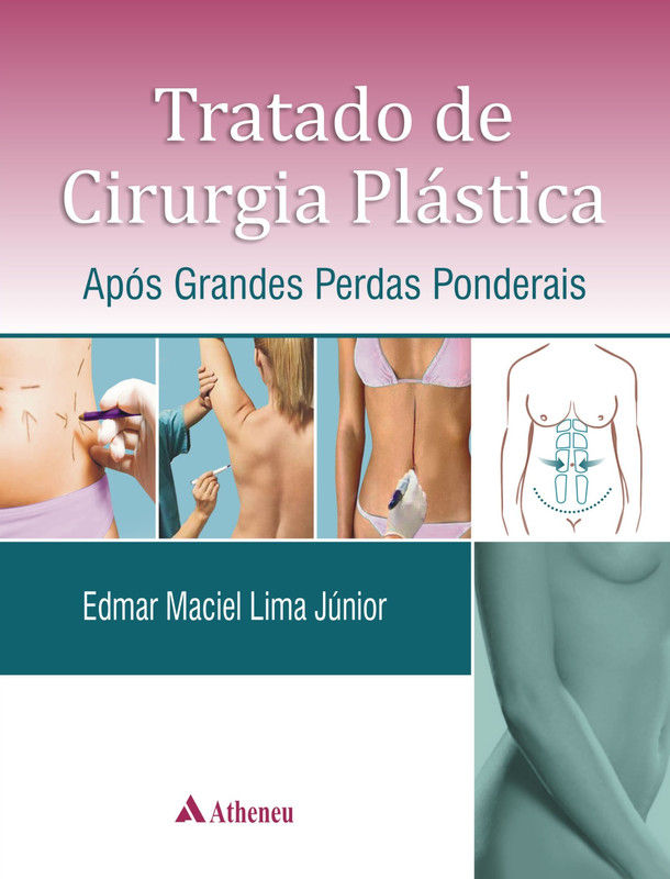 Tratado de Cirurgia Plástica Após Grandes Perdas Ponderais