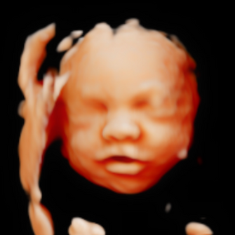 5D/HD Ultrasound Image