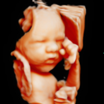 5D/HD Ultrasound Image