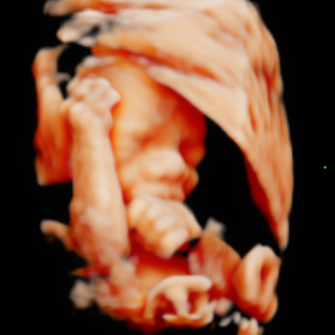 5D/HD Ultrasound Image