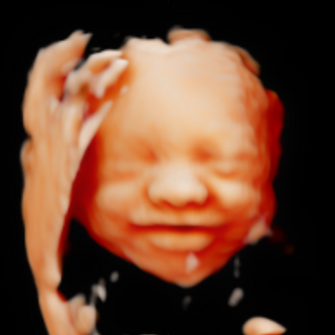 5D/HD Ultrasound Image
