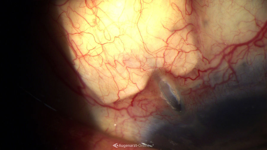 Bindehautperforation mit Sklera Patch bei Ahmed Valve.
