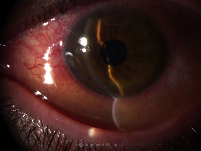 Spaltlampenfoto 2 zu Bindehautchemose bei Uveitis (M Behcet) (links).