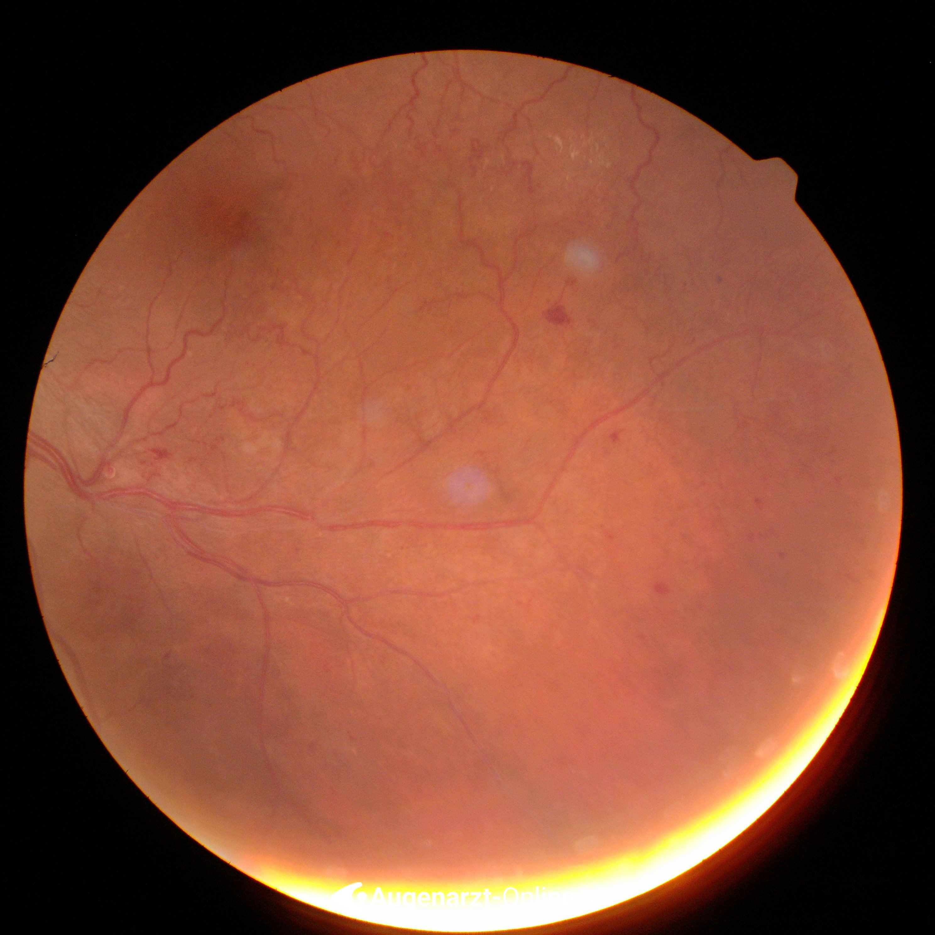 Venenastthrombose | Atlas der Augenheilkunde