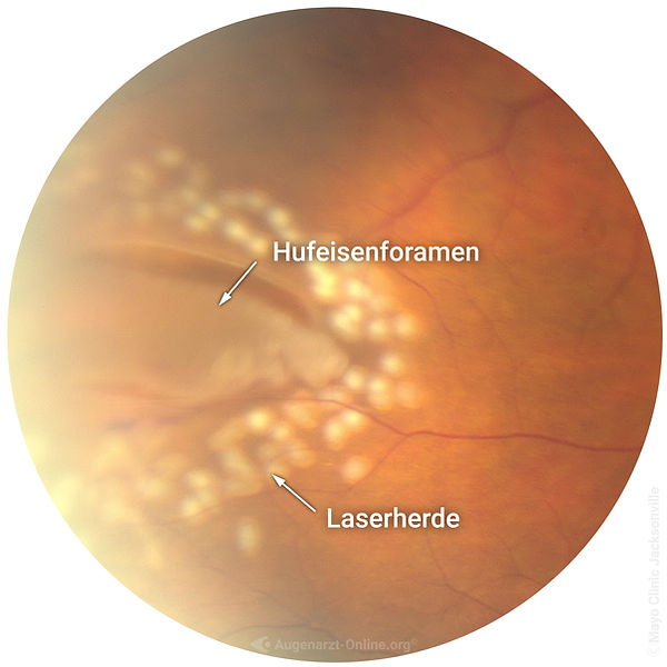 Netzhautriss (Laser umstellt)