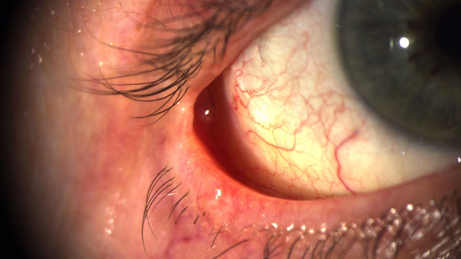 Basaliomexzision am rechten Auge im Spaltlampenfoto. Typisches Erscheinungsbild eines Basaliomexzisions: glasig-weißlich bis rötliche Knötchen mit feinen Äderungen, Wunden und Krusten, die über Wochen nicht abheilen.