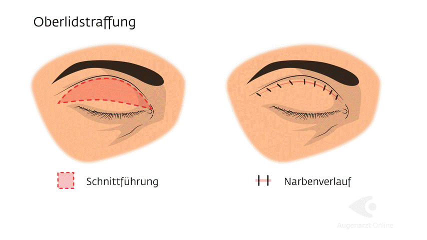 Schlupflider-Operation Vergleich Oberlidstraffung Brauenhebung Ptose.gif