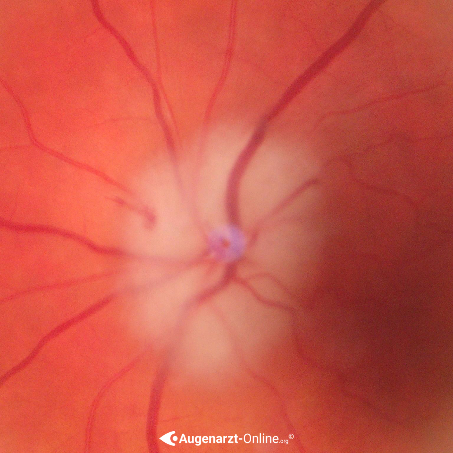 Papillenschwellung bei Arteriitis temporalis