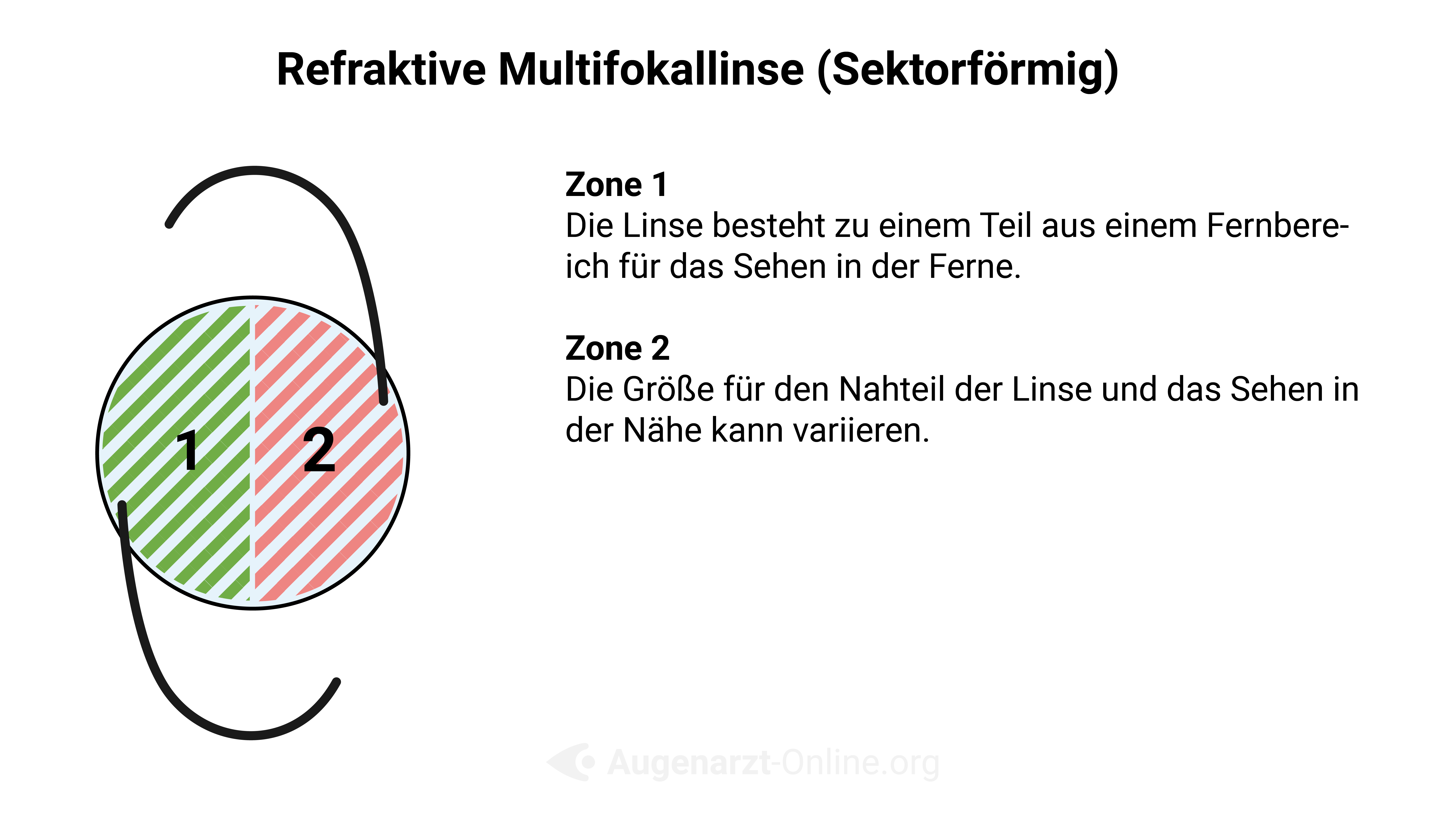 Refraktive Multifokallinse (Sektorförmig)