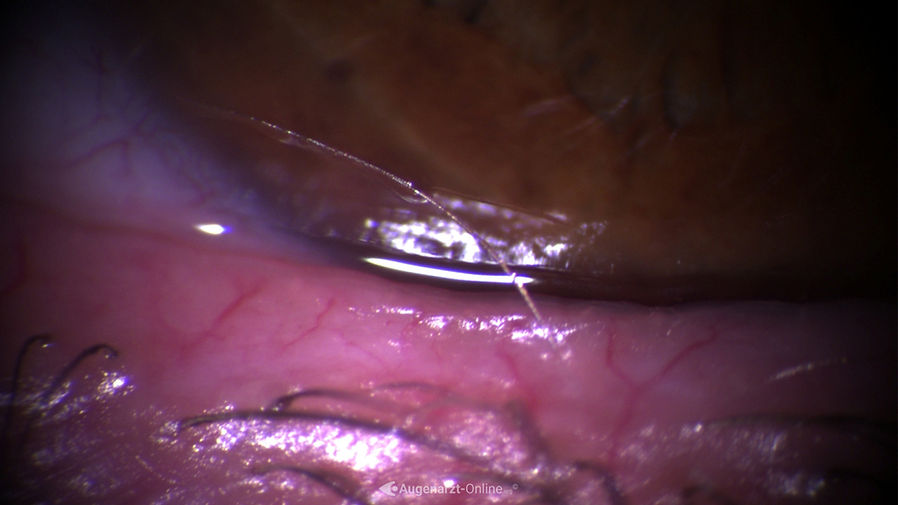Fehlgerichte Wimper am Unterlid und somit Reiben am Auge bei Trichiasis.