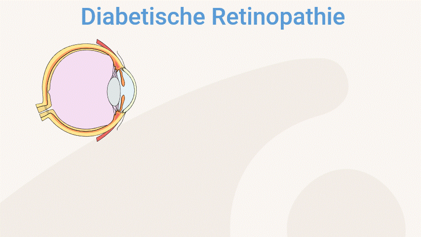Diabetische Retinopathie - Erklärung Animation.gif