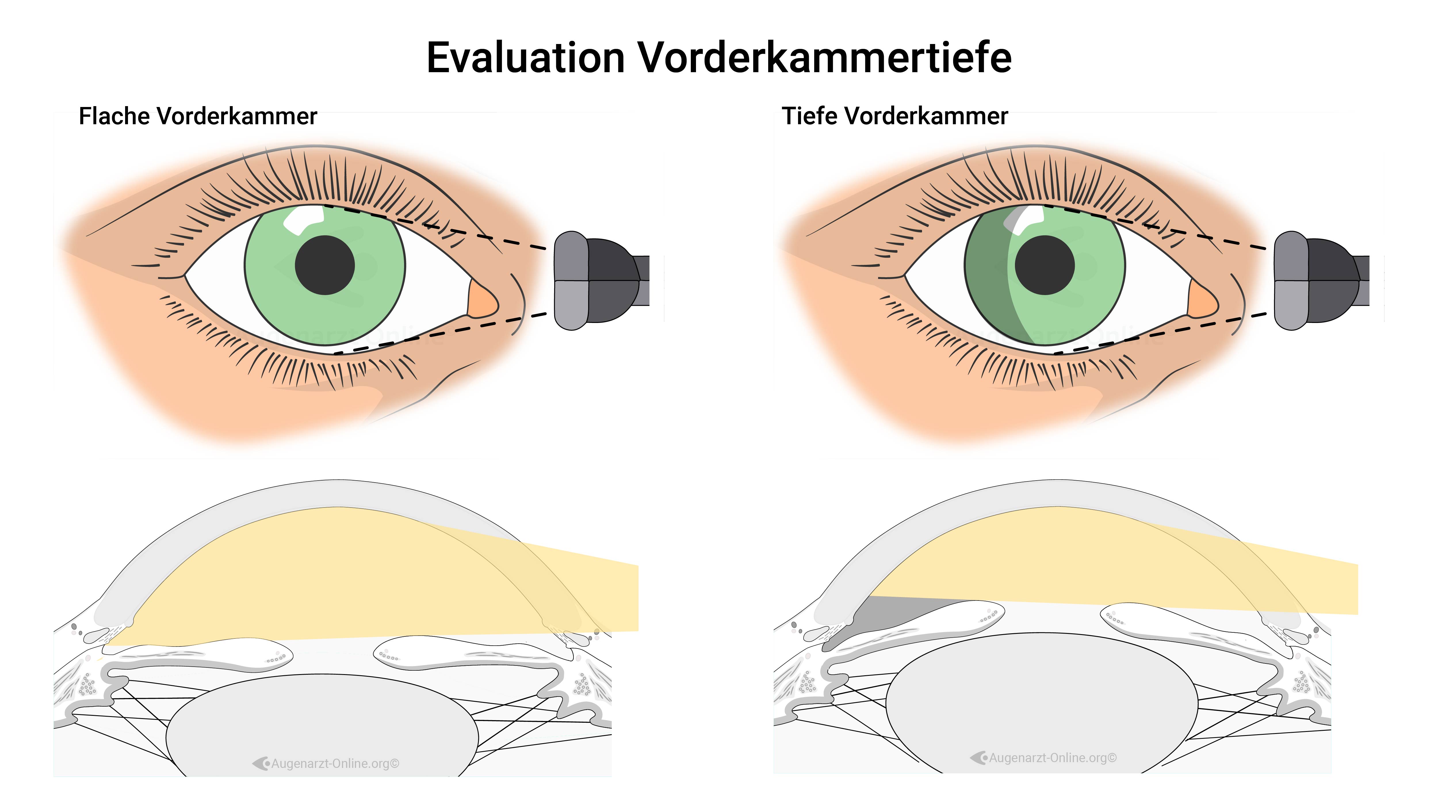 Kammerwinkelbeurteilung