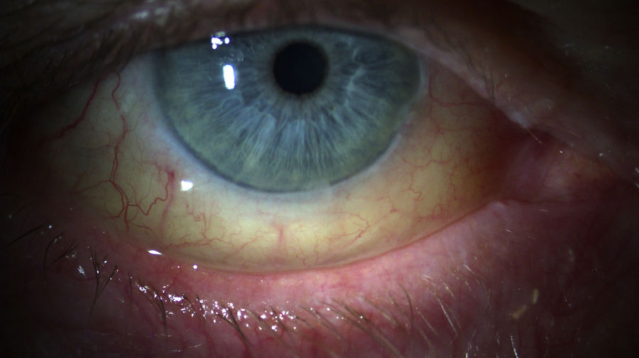 Spaltlampenfoto-Darstellung von Bindehautzyste Differenzialdiagnose Lymphom am rechten Auge. Konjunktivale oder orbitale Lymphome erfordern histologische Sicherung und stadiengerechte onkologische Therapieplanung.