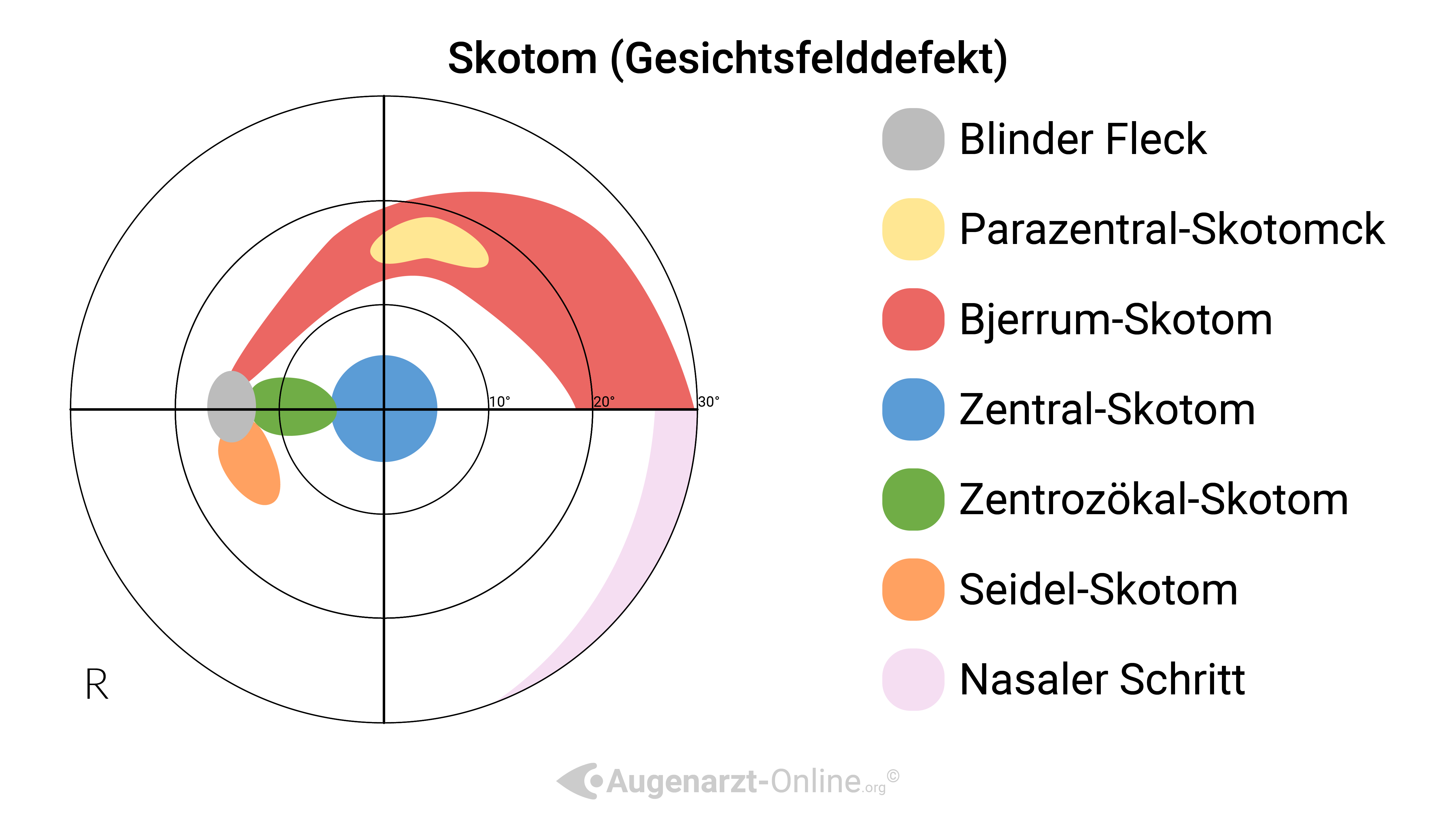 Blinder Fleck, Parazentralskotom, Bjerrum Skotom, Zentral Skotom, Zentrozökal Skotom, Seidel Skotom, Nasaler Schritt