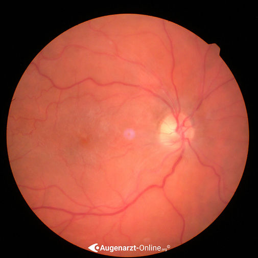 Zartes Glitzern im Bereich der Makula bei epiretinaler Gliose (= epiretinale Membran)