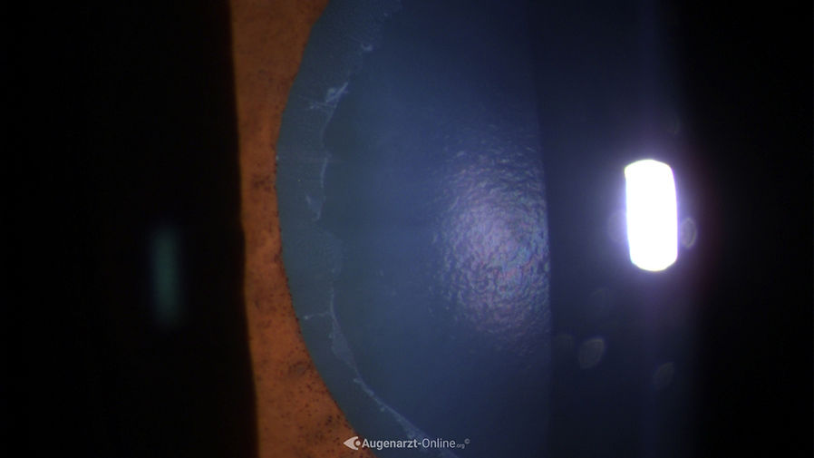 Ablagerungen auf der Linsenvorderfläche bei Pseudoexfoliationssyndrom in der Spaltlampenuntersuchung.