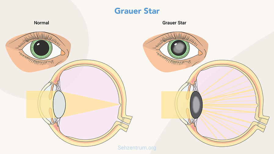 Grafische Übersicht zu Grauer Star (Bei Katarakt wird einfallendes Licht gestreut). Ausgeprägte Linsentrübung bei cataracta matura.