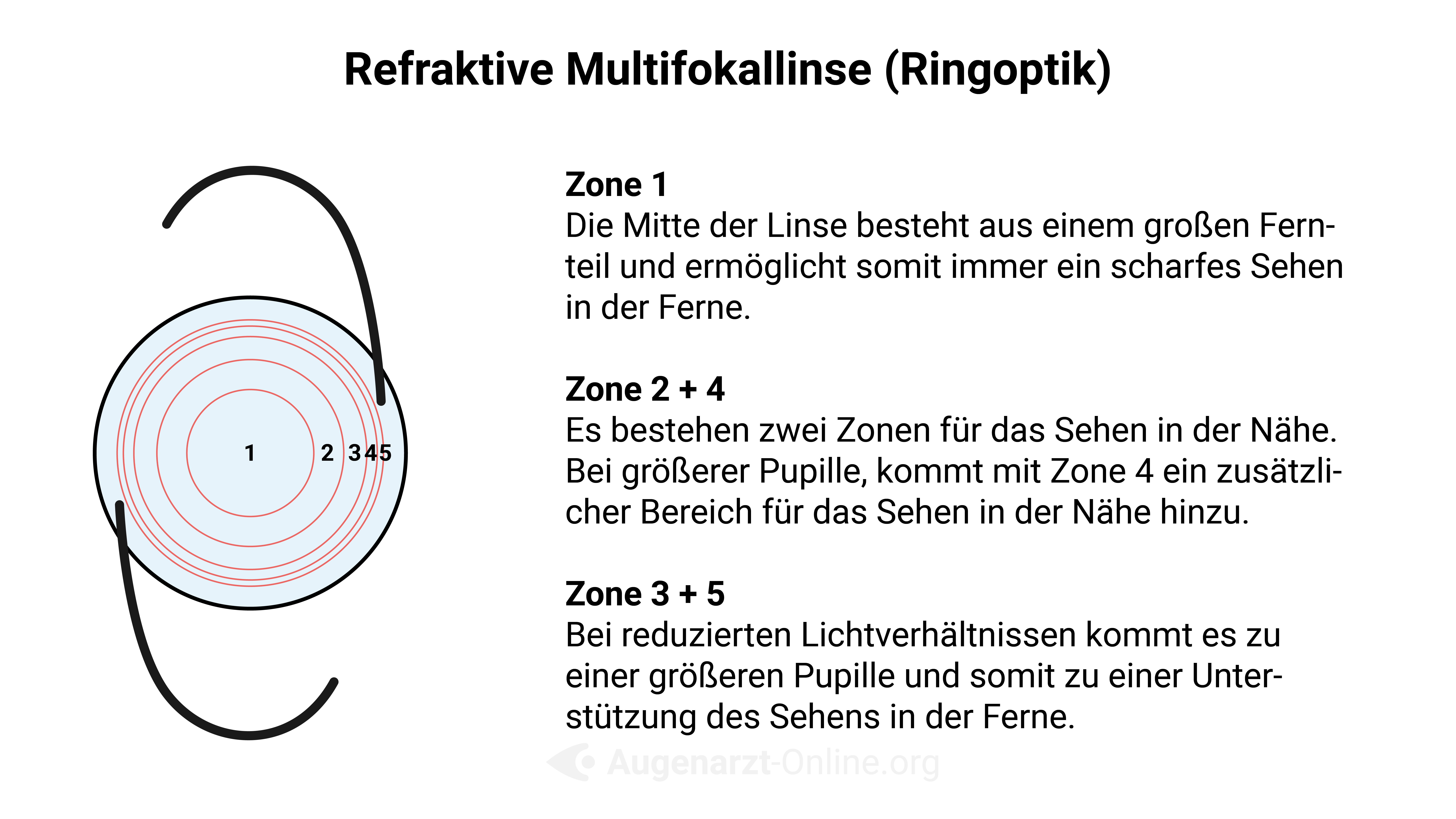 Refraktive Multifokallinse (Ringoptik)