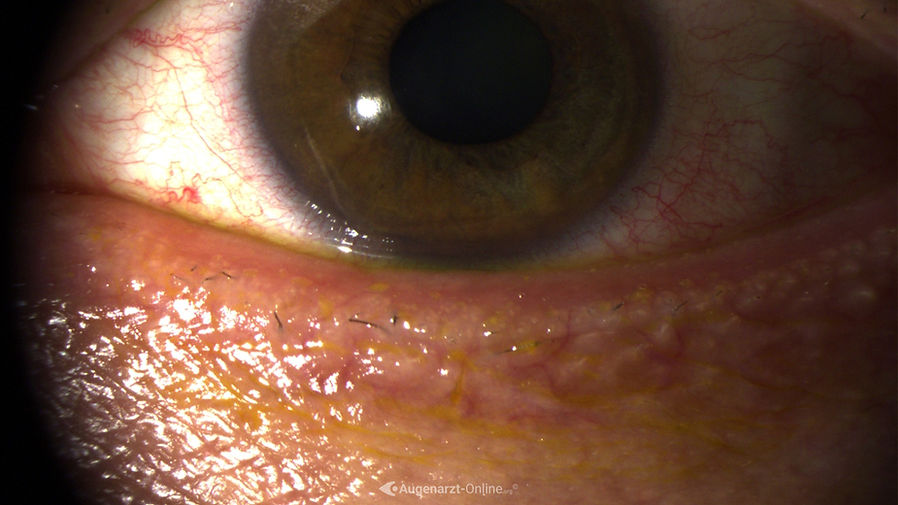 Fehlen von Wimpern nach Ausreißen durch den Patienten bei Trichotillomanie.