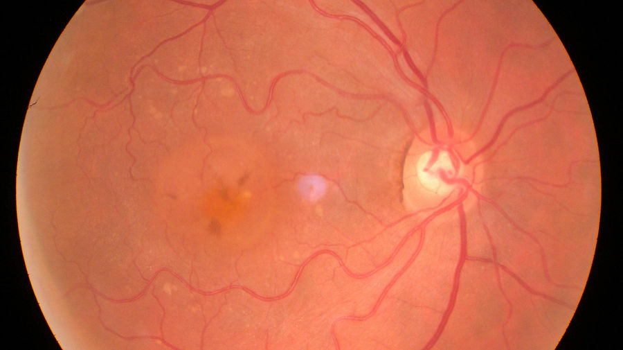 Die Polypoidale choroidale Vaskulopathie (PCV) ist eine Sonderform der choroidalen Neovaskularisationsmebranen (CNV). Hierbei kommt es zu typischen serosangiösen Pigmentepithelabhebung die meist als orangefarben Läsionen im papillovasulären Bündel auftreten.